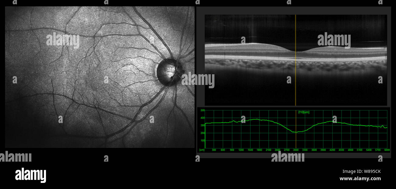Prova oftalmica - PTOM, tomografia di coerenza ottica misura. SLO vista di scansione della macula nella retina con navi Foto Stock