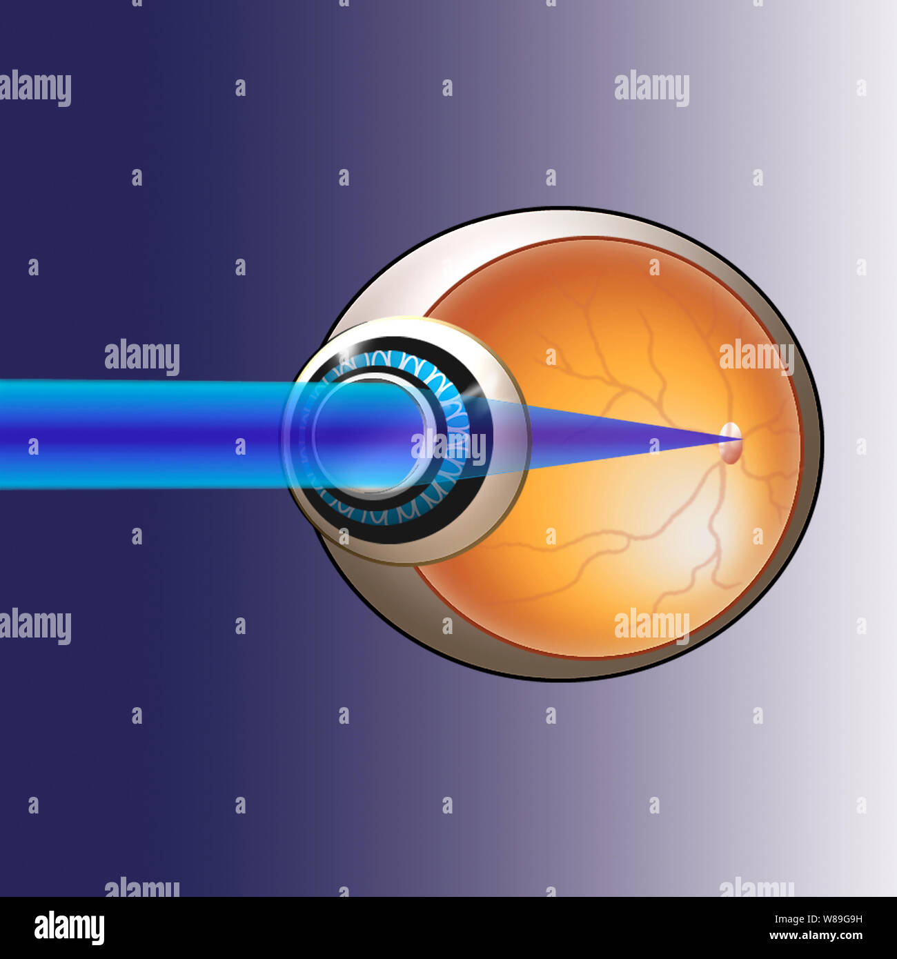 Eyeball, illustrazione visualizzazione lungimirante utilizzando raggi che entrano nell'occhio al punto focale Foto Stock