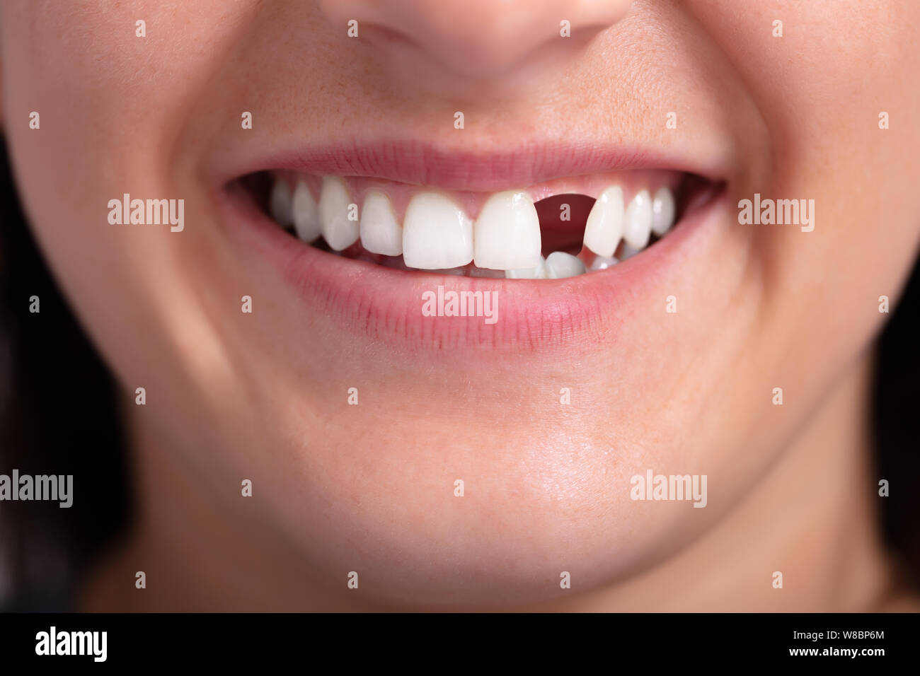 Close up Foto di giovane donna con il dente mancante Foto Stock
