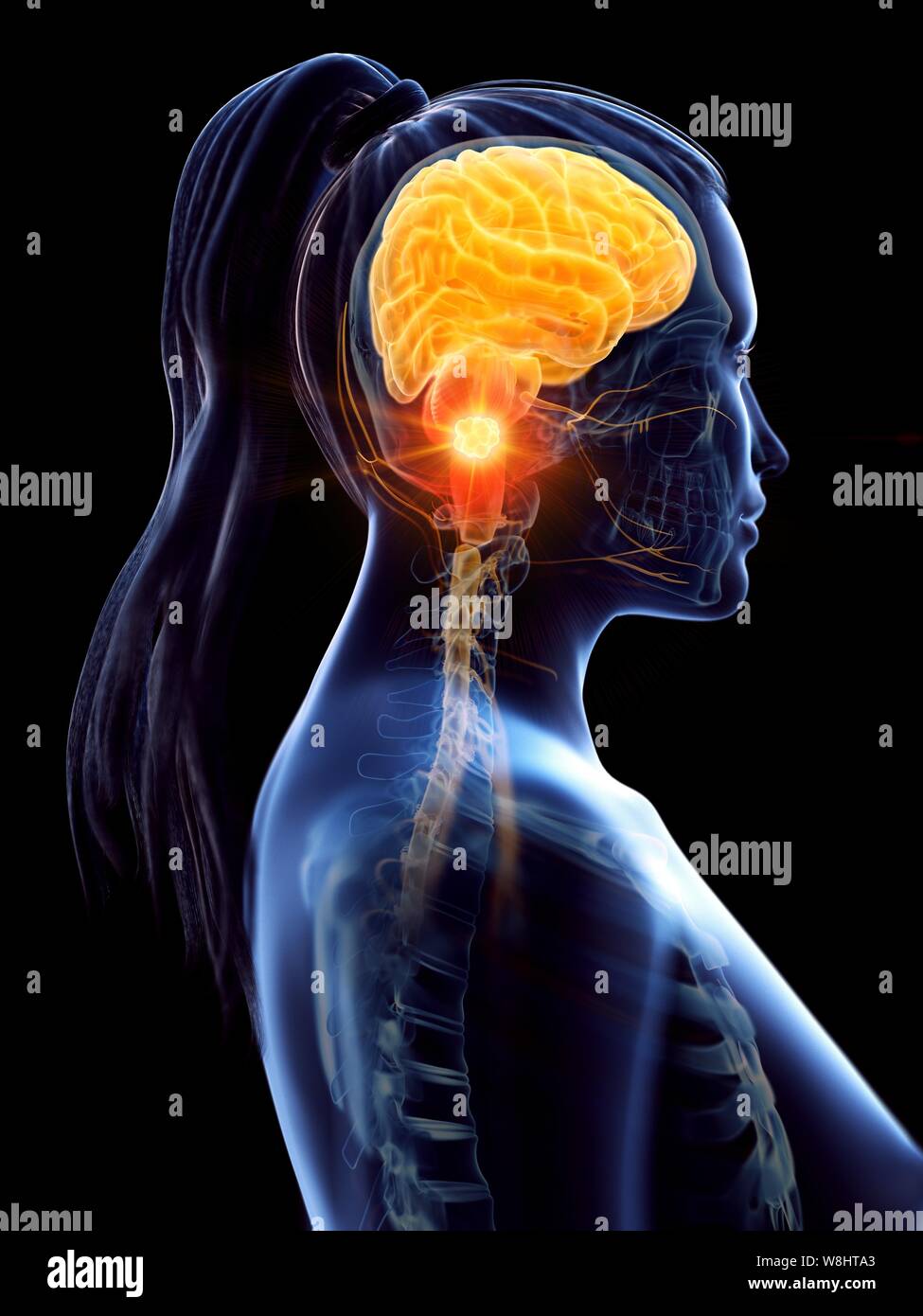 Brain cancer, concettuale illustrazione del computer. Foto Stock