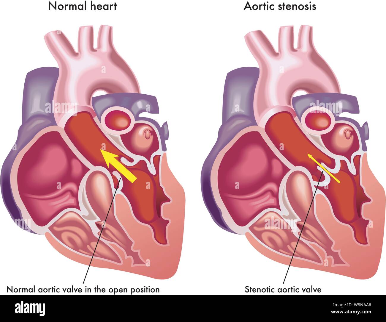 Illustrazione medica dei sintomi della stenosi aortica. Illustrazione Vettoriale