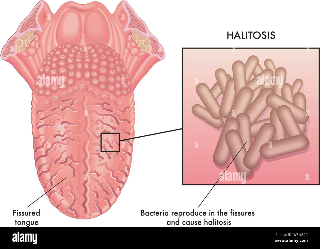 Illustrazione medica di una causa di alitosi Illustrazione Vettoriale