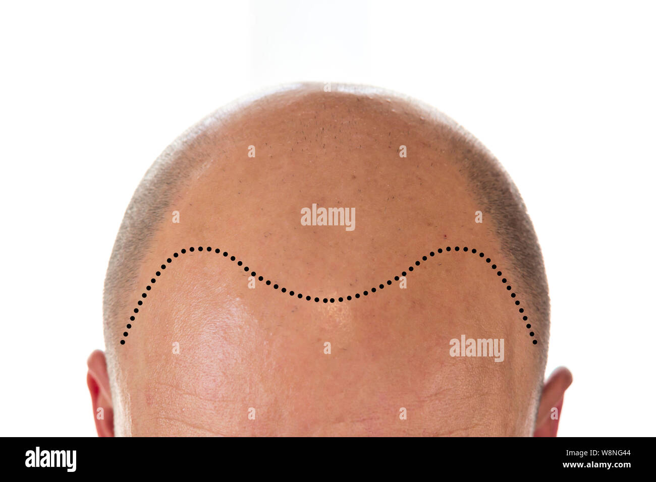 Vista di uomo calvo di testa con la perdita di capelli e la linea sfuggente Foto Stock