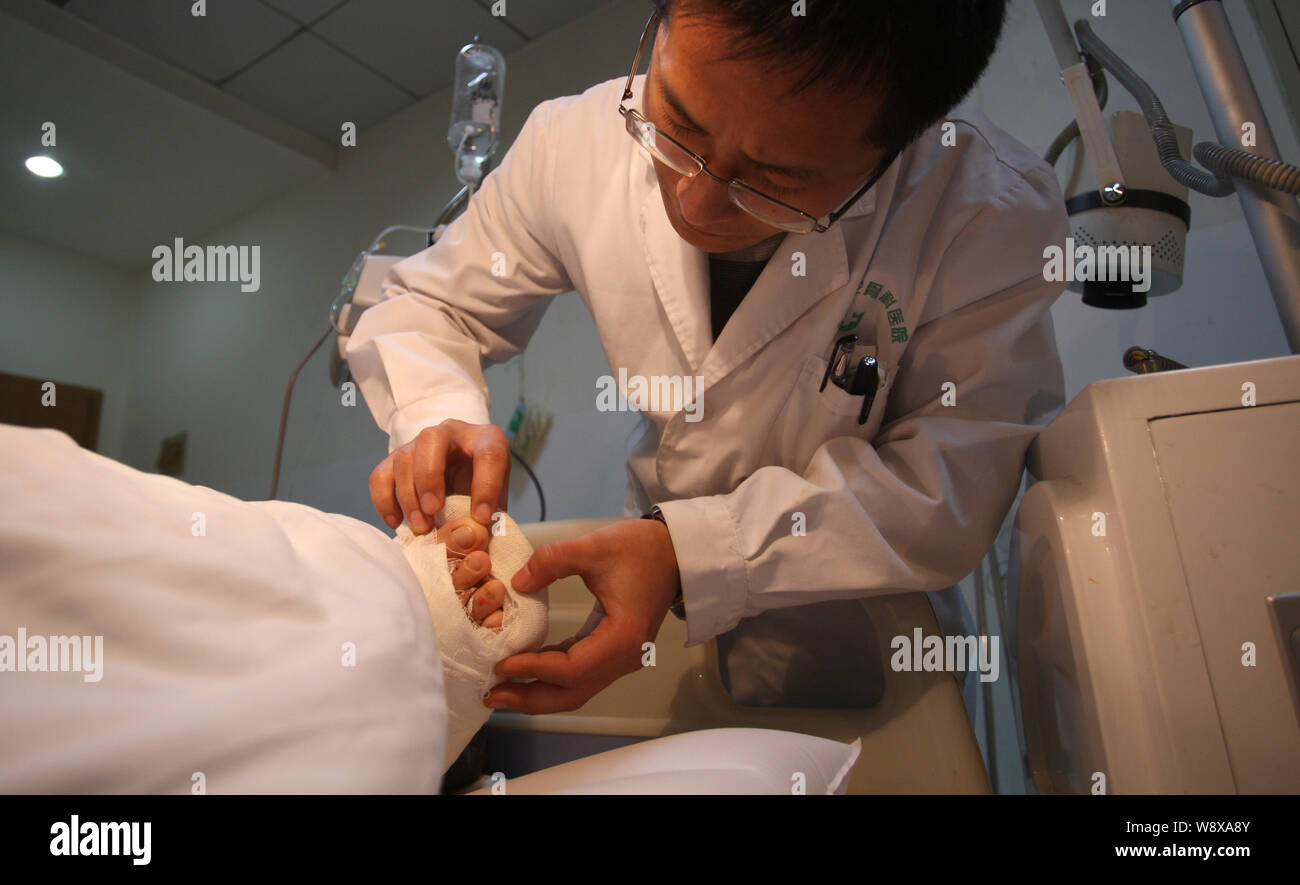 Un medico esamina il piede destro di un Yuan dopo un intervento chirurgico per trapianto di un suo piede destro per sostituire la sua sinistra anello dito a NianLun Ortopedia Foto Stock