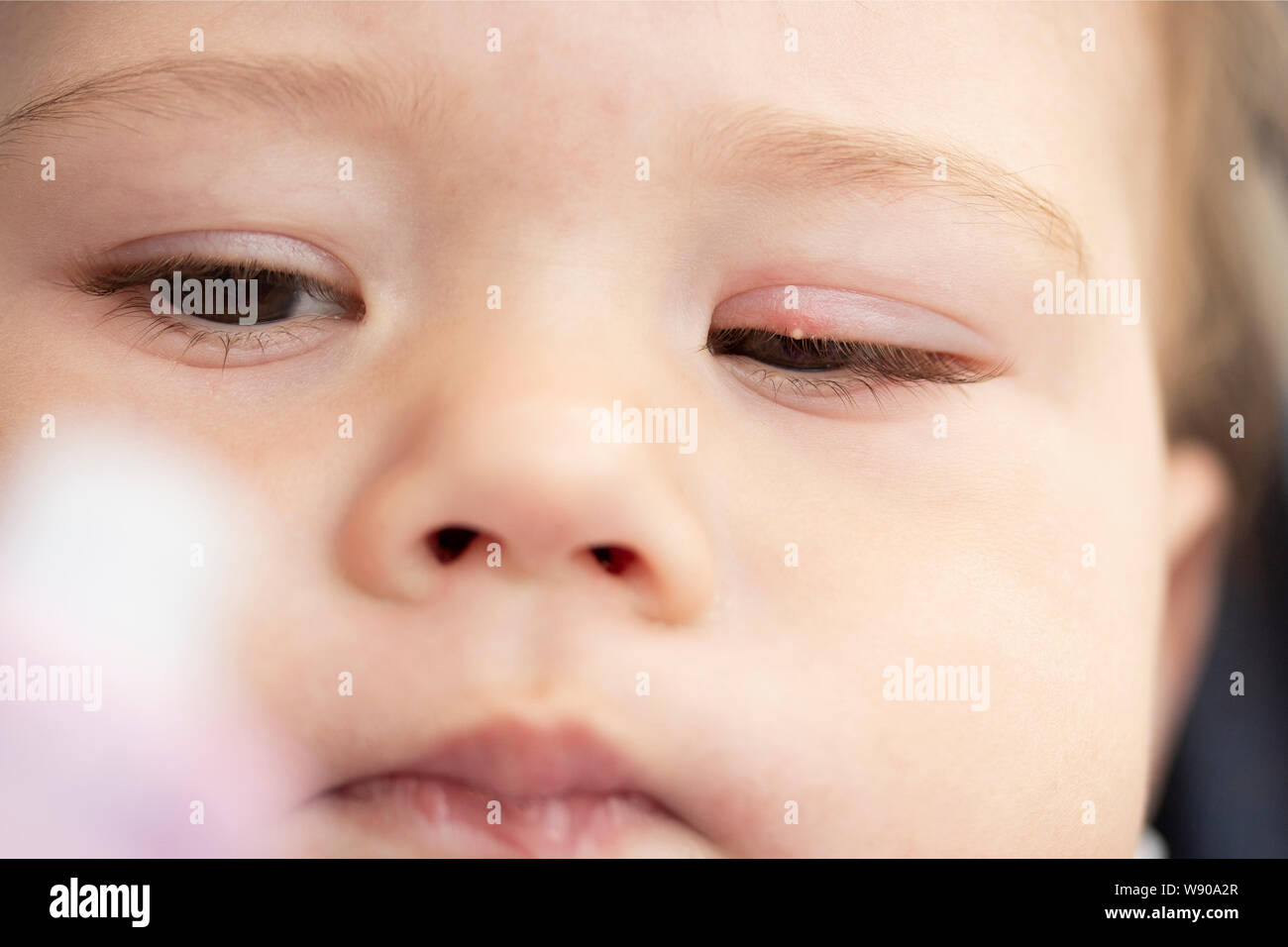 White brufolo sulle palpebre di un piccolo bambino di close-up. Infiammazione dell'occhio milium congiuntivite. Infiammazione della palpebra superiore soft focus Foto Stock