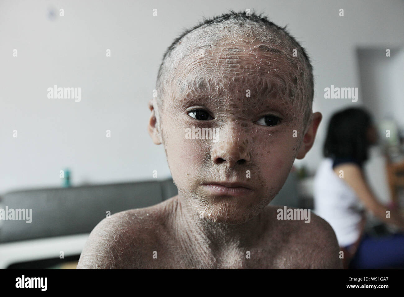 Pan Xianhang, il 8-anno-vecchio ragazzo che ha fishskin-pelle sagomato che copre tutto il suo corpo, rimane nella sua casa di Wenling, est Chinas nella provincia di Zhejiang, 26 Foto Stock