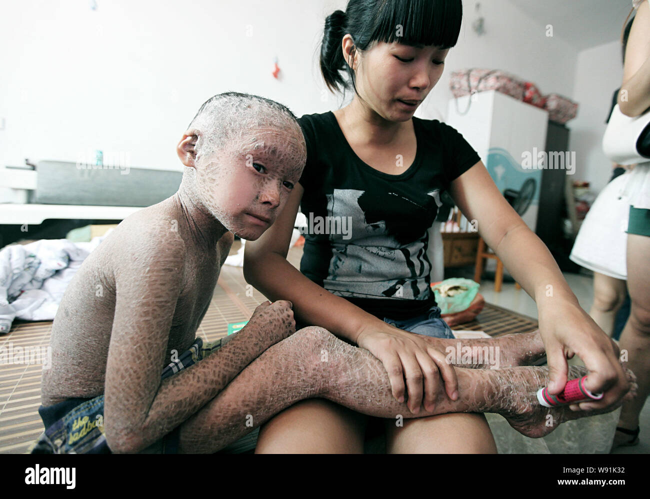 Pan Xianhangs madre applica alcune unguento sullato gamba del 8-anno-vecchio ragazzo che ha fishskin-pelle sagomato che copre tutto il suo corpo in casa loro a Wenl Foto Stock