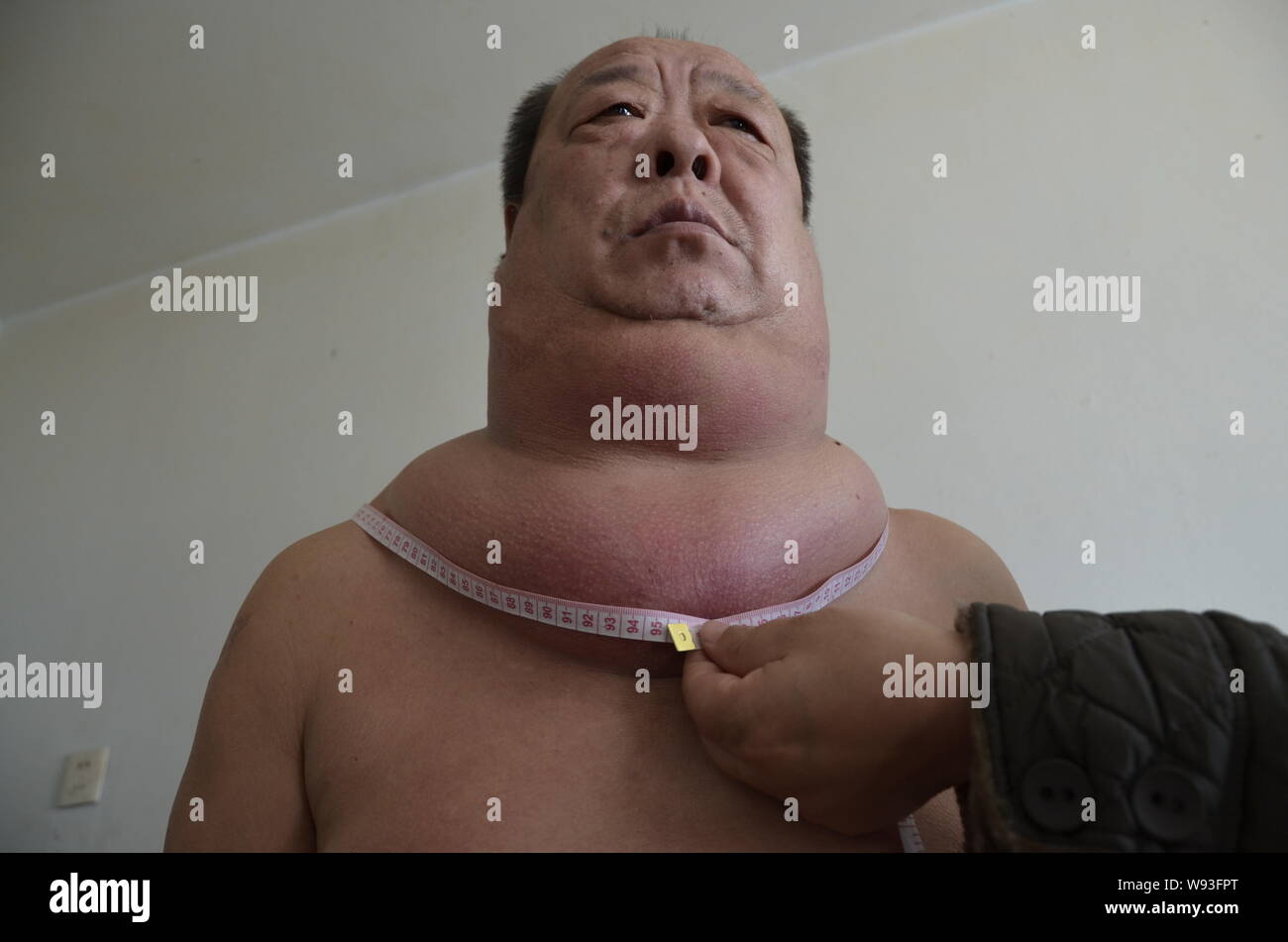 I membri della famiglia misura la dimensione del tumore al collo del signor Wang Zhixiang, nella sua casa nella città di Jilin, nordest Chinas provincia di Jilin, 16 marzo 201 Foto Stock