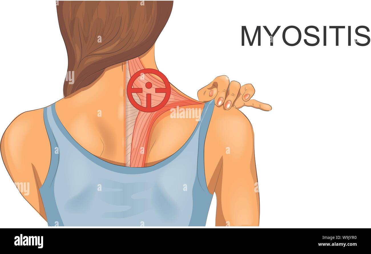 Illustrazione vettoriale di muscolo trapezius. l'incidenza della miosite Illustrazione Vettoriale