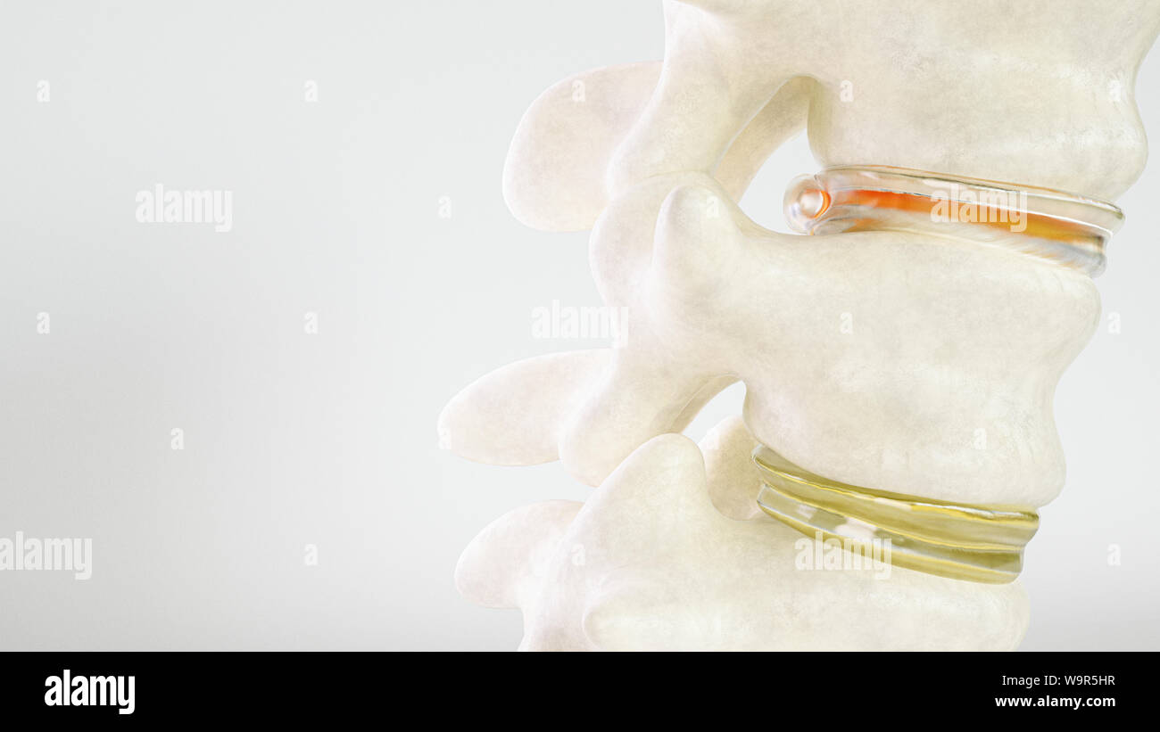 Spinale ernia del disco come close-up come il rendering 3D Foto Stock