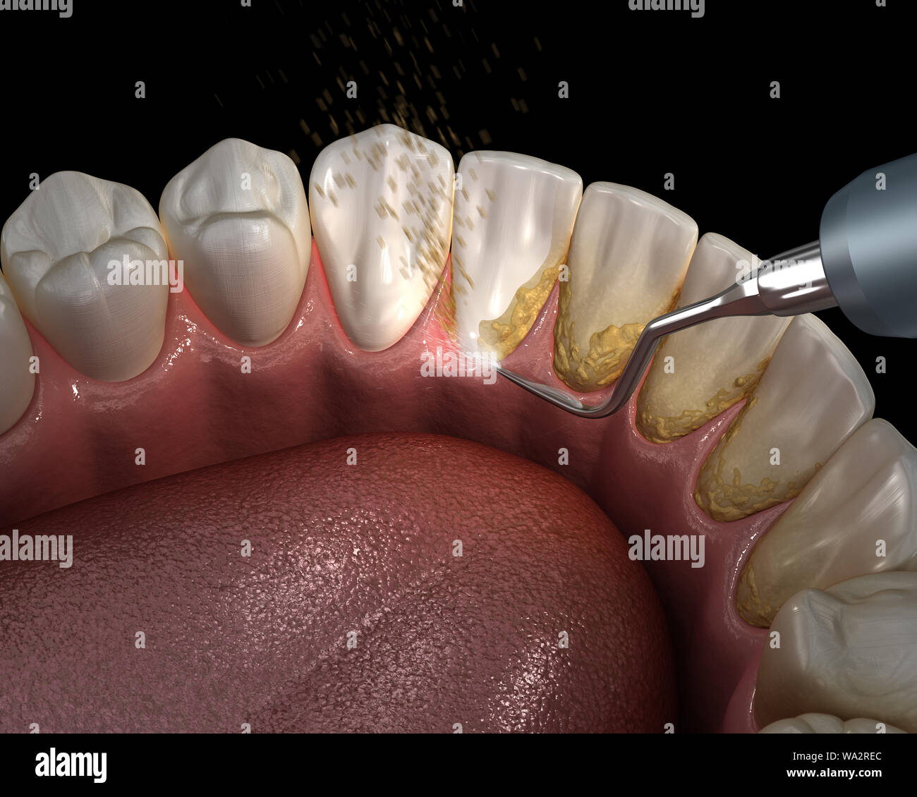 Igiene orale: denti ad ultrasuoni macchina per la pulizia la rimozione del  tartaro e della placca. Accurata dal punto di vista medico 3D illustrazione dei  denti umani il trattamento Foto stock -