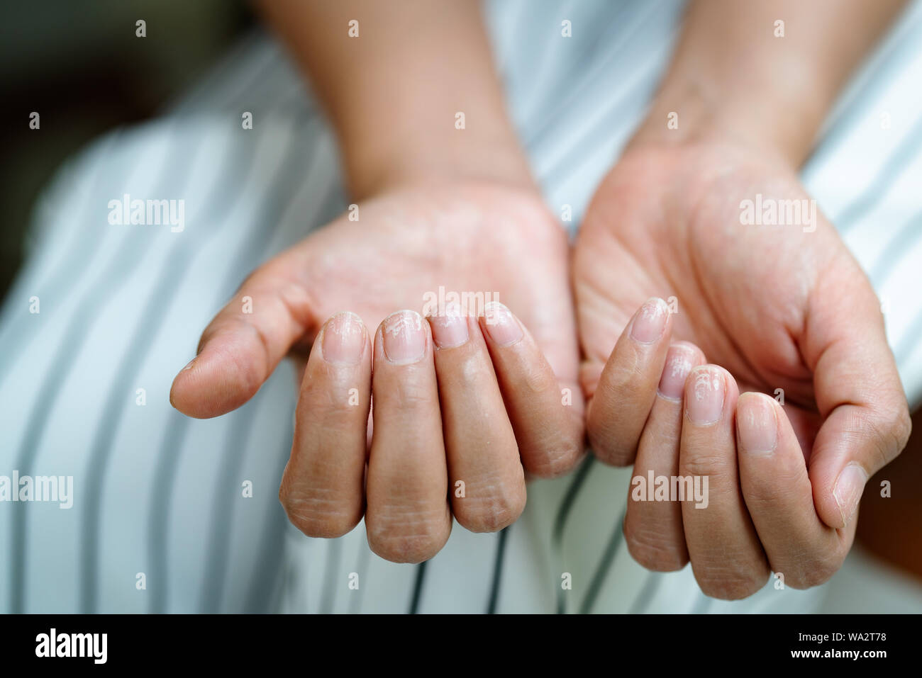 Fragile chiodi danneggiato dopo l'utilizzo di gomma lacca o gel-lacca Foto Stock