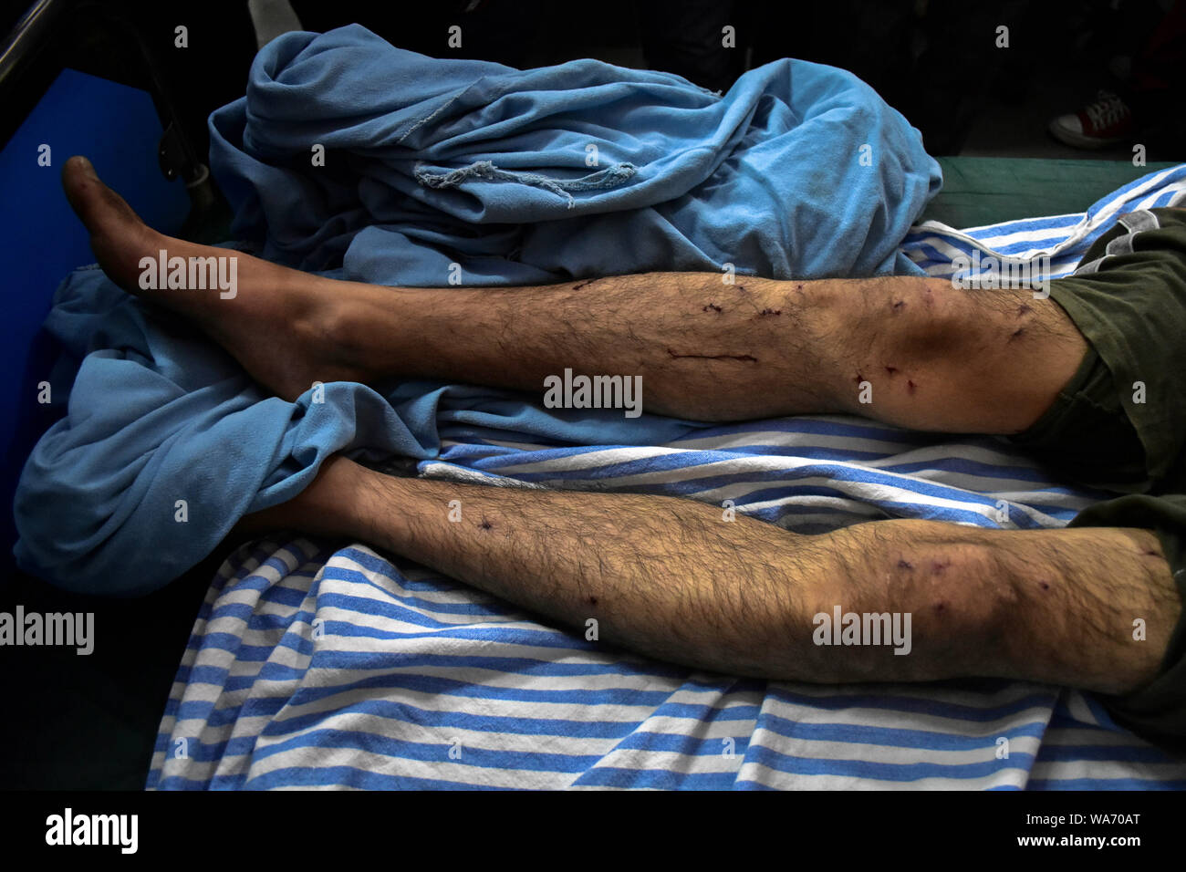 Le gambe di un ferito Kashmir protester presso un ospedale durante il coprifuoco a Srinagar.rigido coprifuoco e una totale comunicazione blackout in Kashmir valley in seguito alla decisione presa dal governo centrale di rottami di articolo 370 che concede uno statuto speciale di Jammu e Kashmir. Foto Stock
