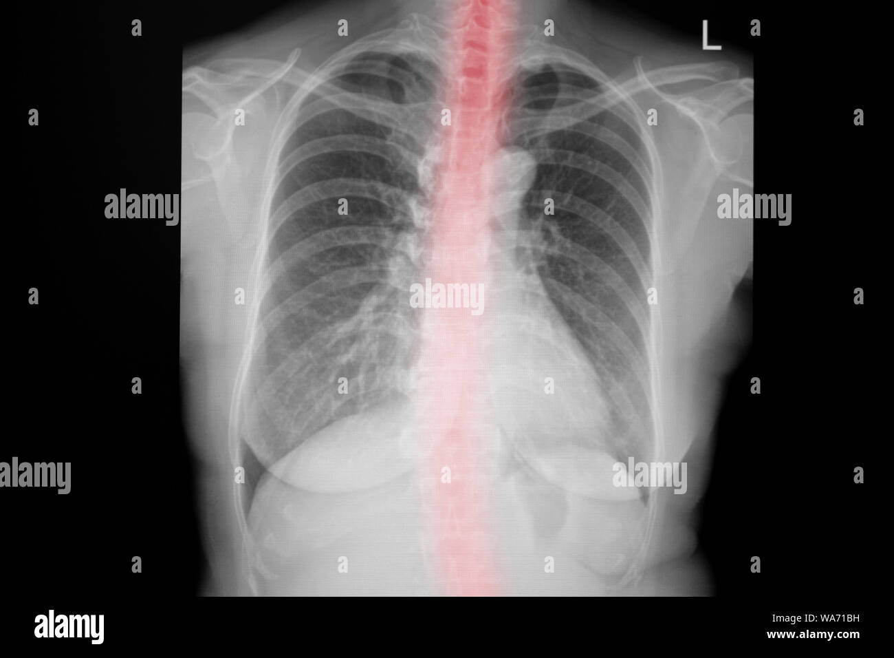 I raggi X al torace dell'immagine. Immagine a raggi X del torace dell'uomo per una diagnosi medica. Foto Stock I raggi X al torace dell'immagine. Immagine a raggi X del torace dell'uomo per una diagnosi medica. Foto Stock