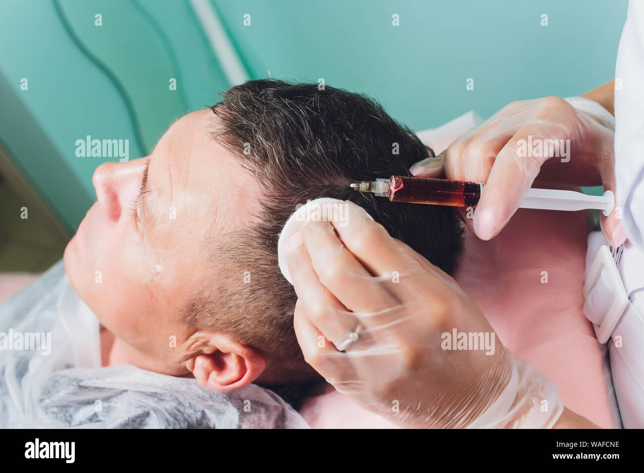 Trattamento della calvizie con iniezioni di bellezza. Cosmetologo mani guanti nel fare una iniezione sottocutanea. Plasmalifting paziente di sesso maschile Foto Stock