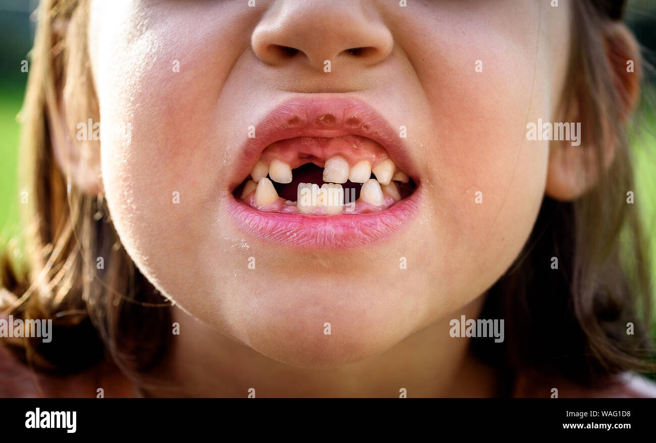 Ritratto di bambino priva di denti mancanti ragazza latte e denti permanenti. Primo piano del giovane capretto con denti lacune e permanente in crescita i denti e le gengive sane p Foto Stock