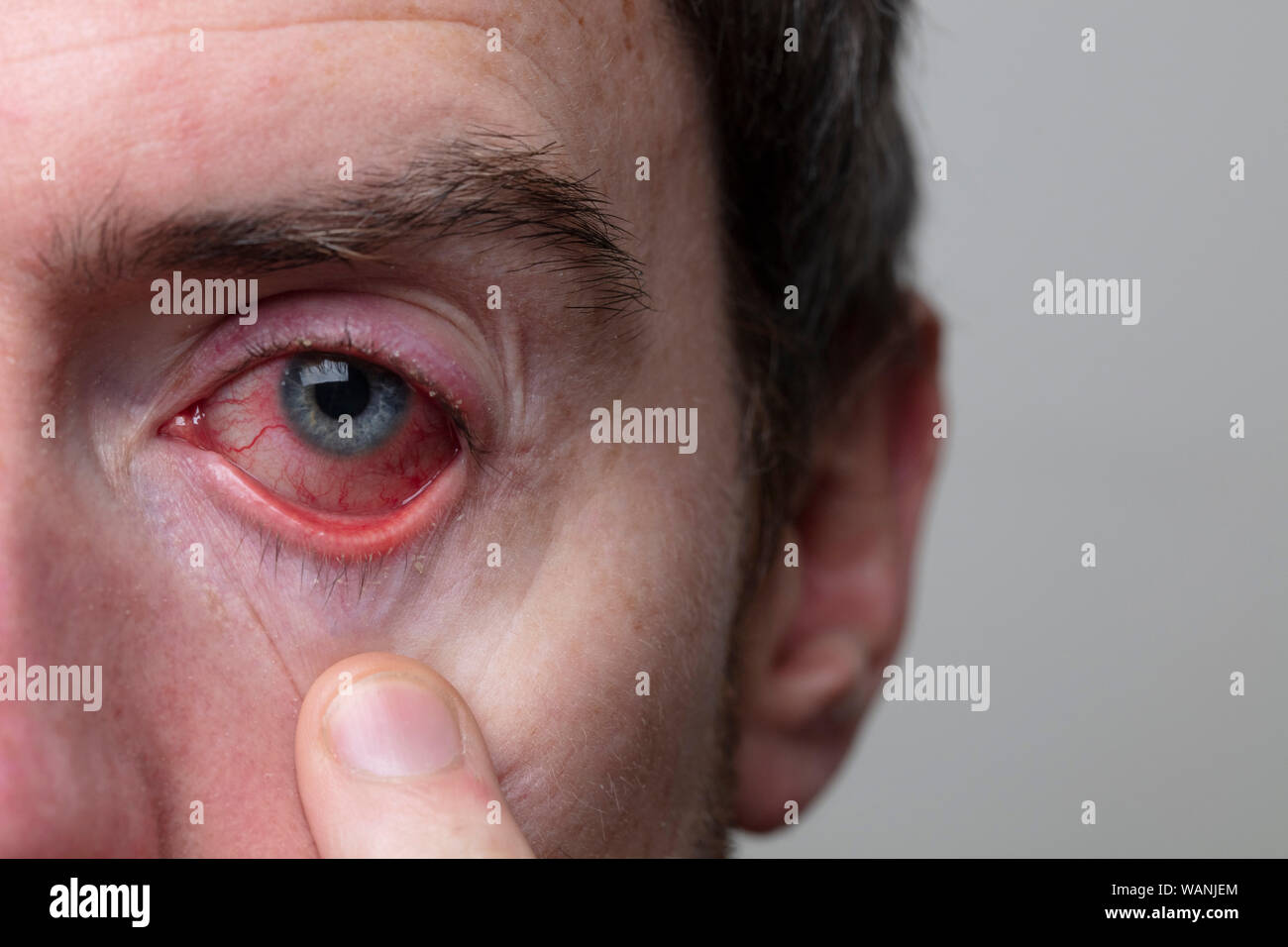 Close up di un grave occhio sanguinari. Blefarite congiuntivite condizione Foto Stock