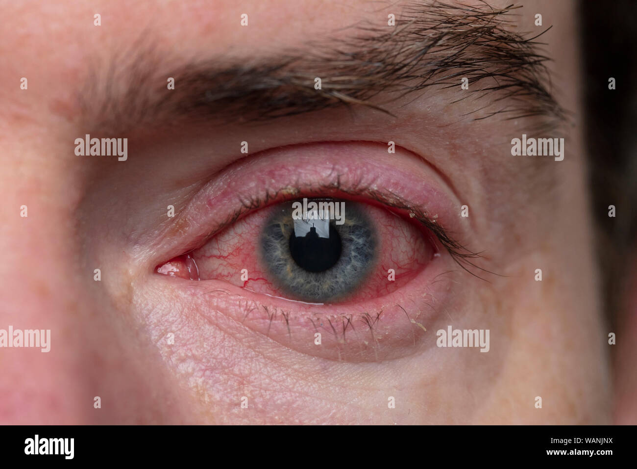 Close up di un grave occhio sanguinari. Blefarite congiuntivite condizione Foto Stock