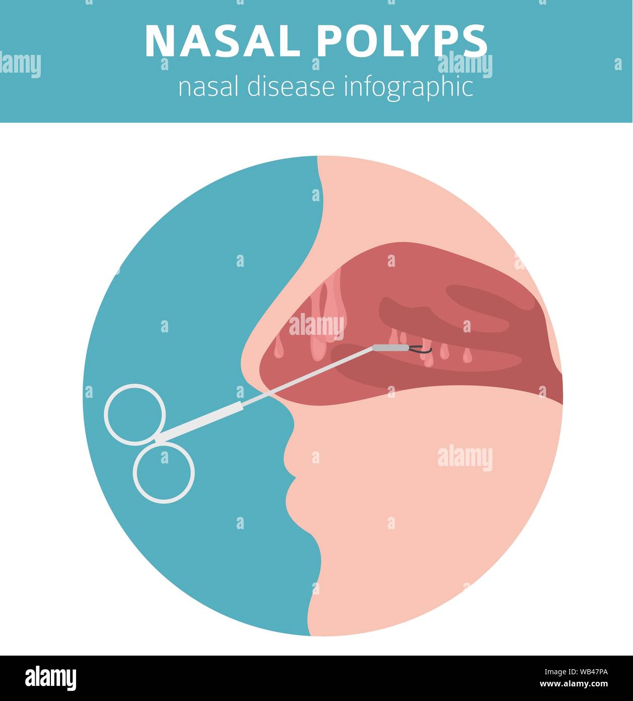 Malattie nasali. Polipi nasali provoca, la diagnosi e il trattamento medico design infografico. Illustrazione Vettoriale Illustrazione Vettoriale