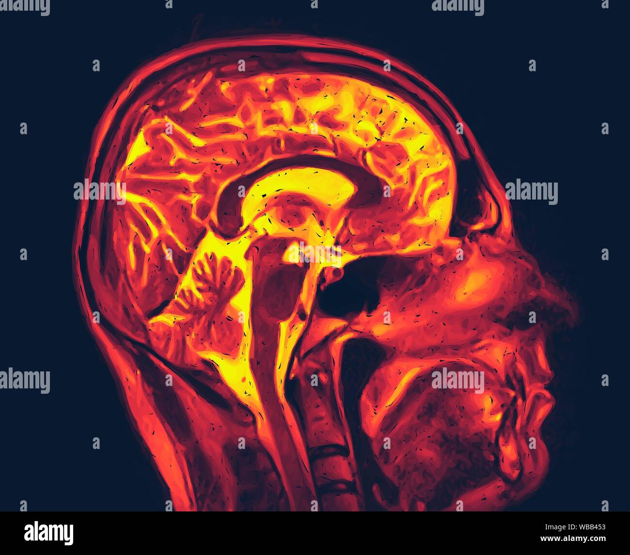 Il rilevamento di immagini in risonanza magnetica nucleare del cervello con nessuna anormalità visibili. MRI illustrazione vettoriale. Foto Stock