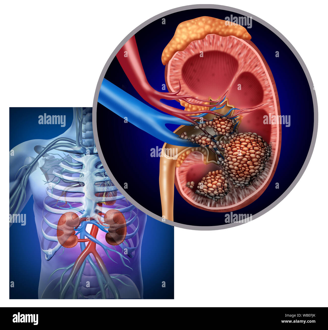 Il cancro del rene concetto medico come cellule maligne in un corpo umano che attacca il sistema urinario e anatomia renale. Foto Stock