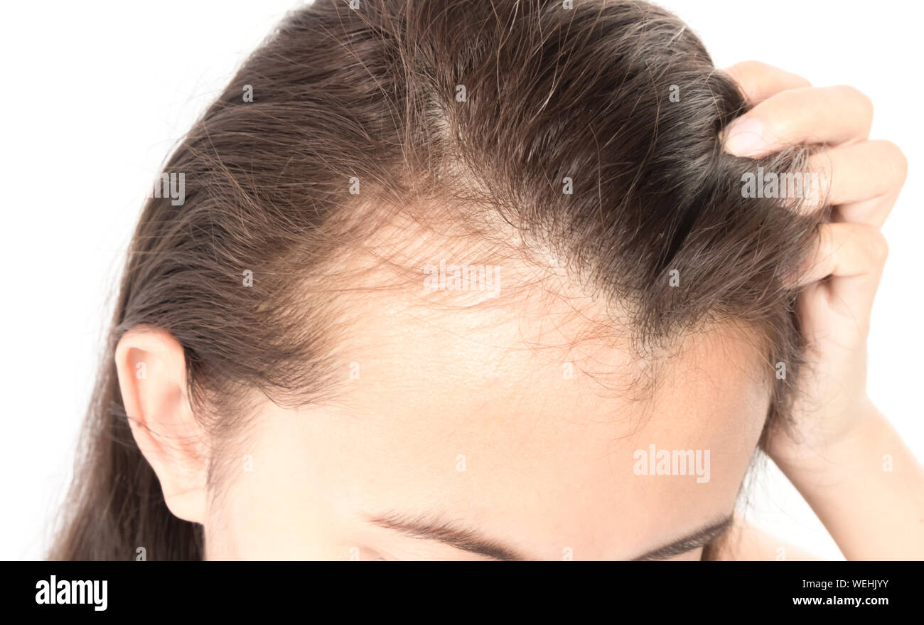 Close-up di giovane donna con perdita di capelli contro uno sfondo bianco Foto Stock