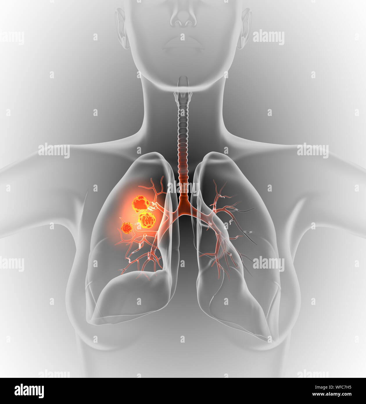 Medical illustrazione che mostra il cancro del polmone o carcinoma bronchiale su sfondo nero, 3D illustrazione Foto Stock
