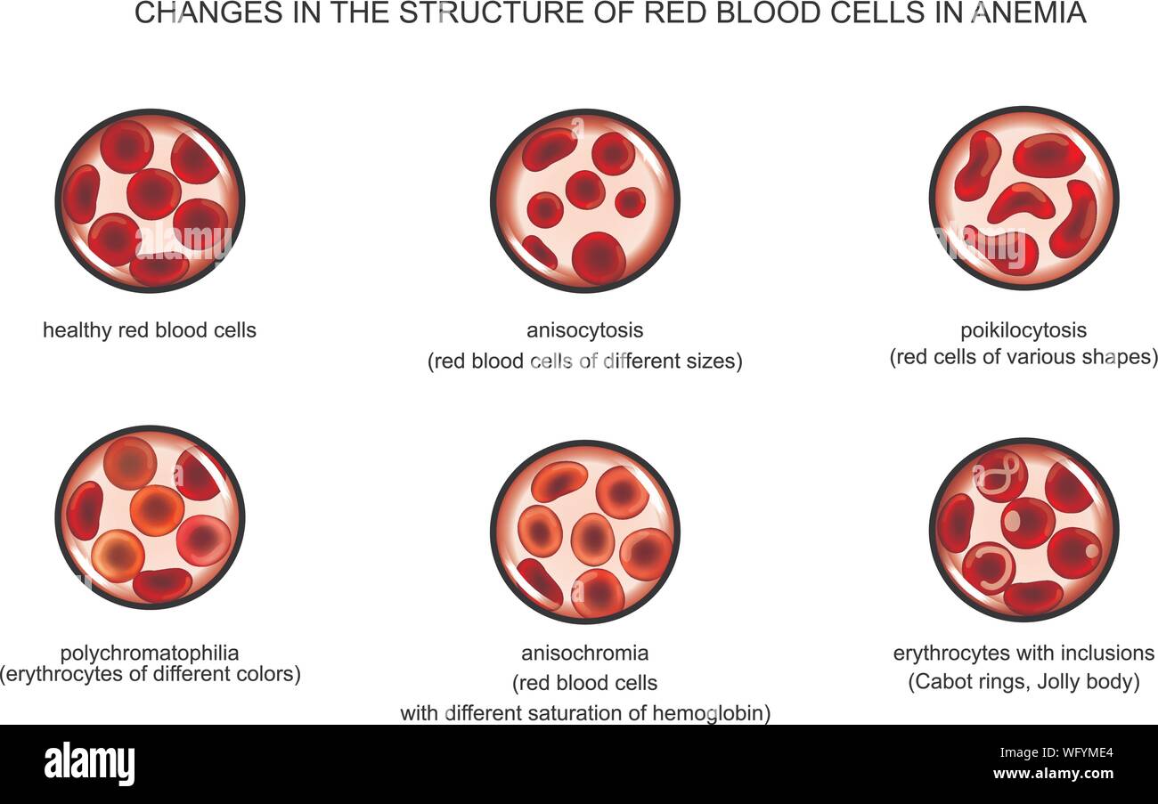 Illustrazione vettoriale della struttura di cellule rosse del sangue in varie anemie Illustrazione Vettoriale