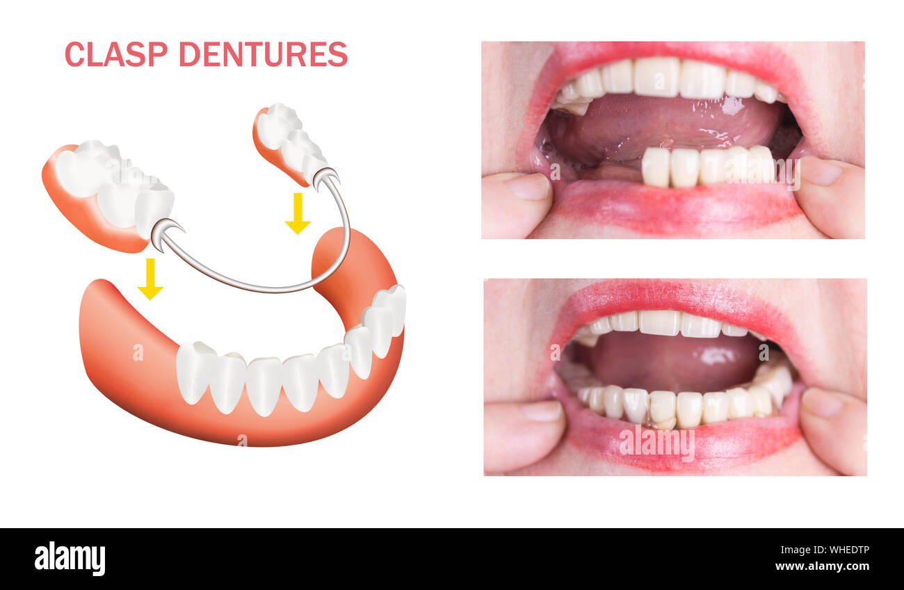 Riabilitazione dentale con superiore e inferiore protesi, prima e dopo il trattamento Foto Stock