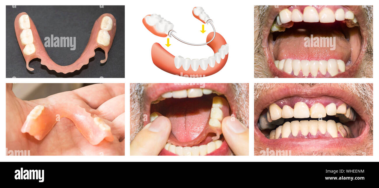 Riabilitazione dentale con superiore e inferiore protesi, prima e dopo il trattamento Foto Stock