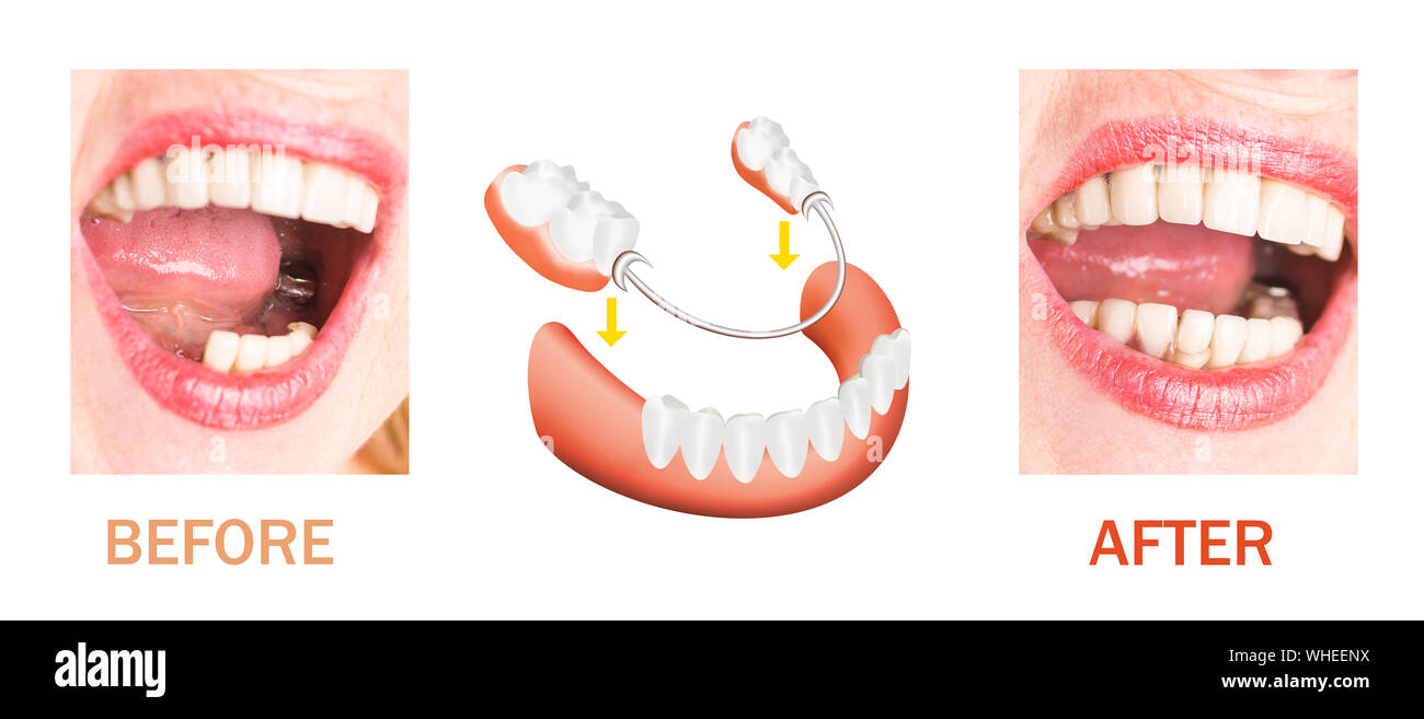 Riabilitazione dentale con superiore e inferiore protesi, prima e dopo il trattamento Foto Stock