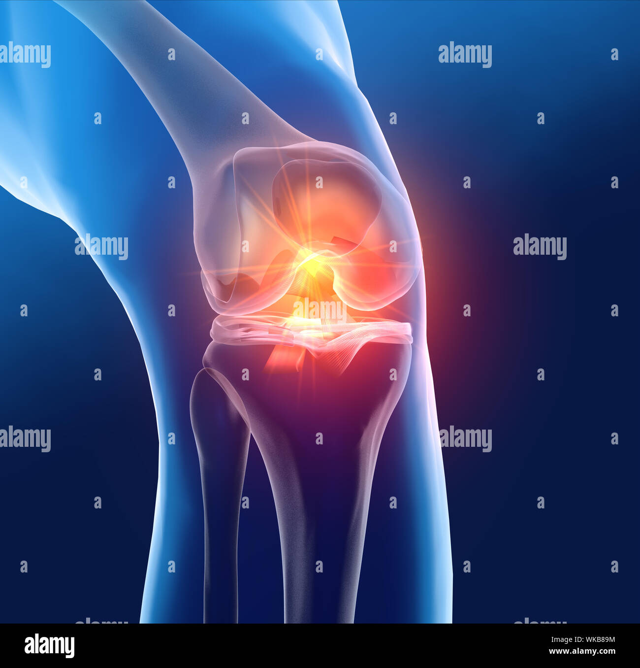 Dal punto di vista medico accurato 3D illustrazione che mostra la dolorosa del ginocchio con evidenziati anteriore e legamento crociato posteriore, menisco, la cartilagine articolare Foto Stock