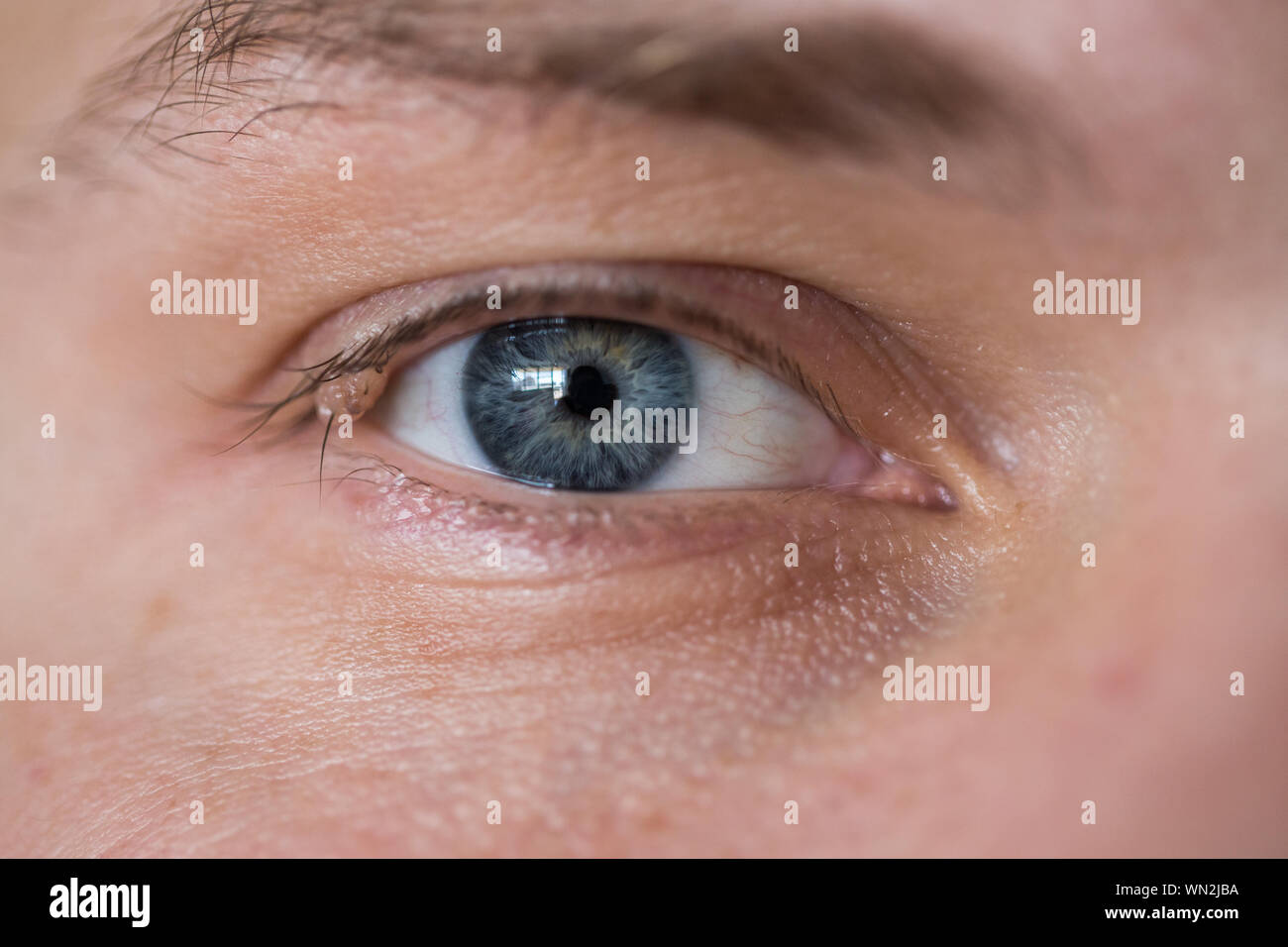 Occhio con mole in macro immagine. Foto Stock