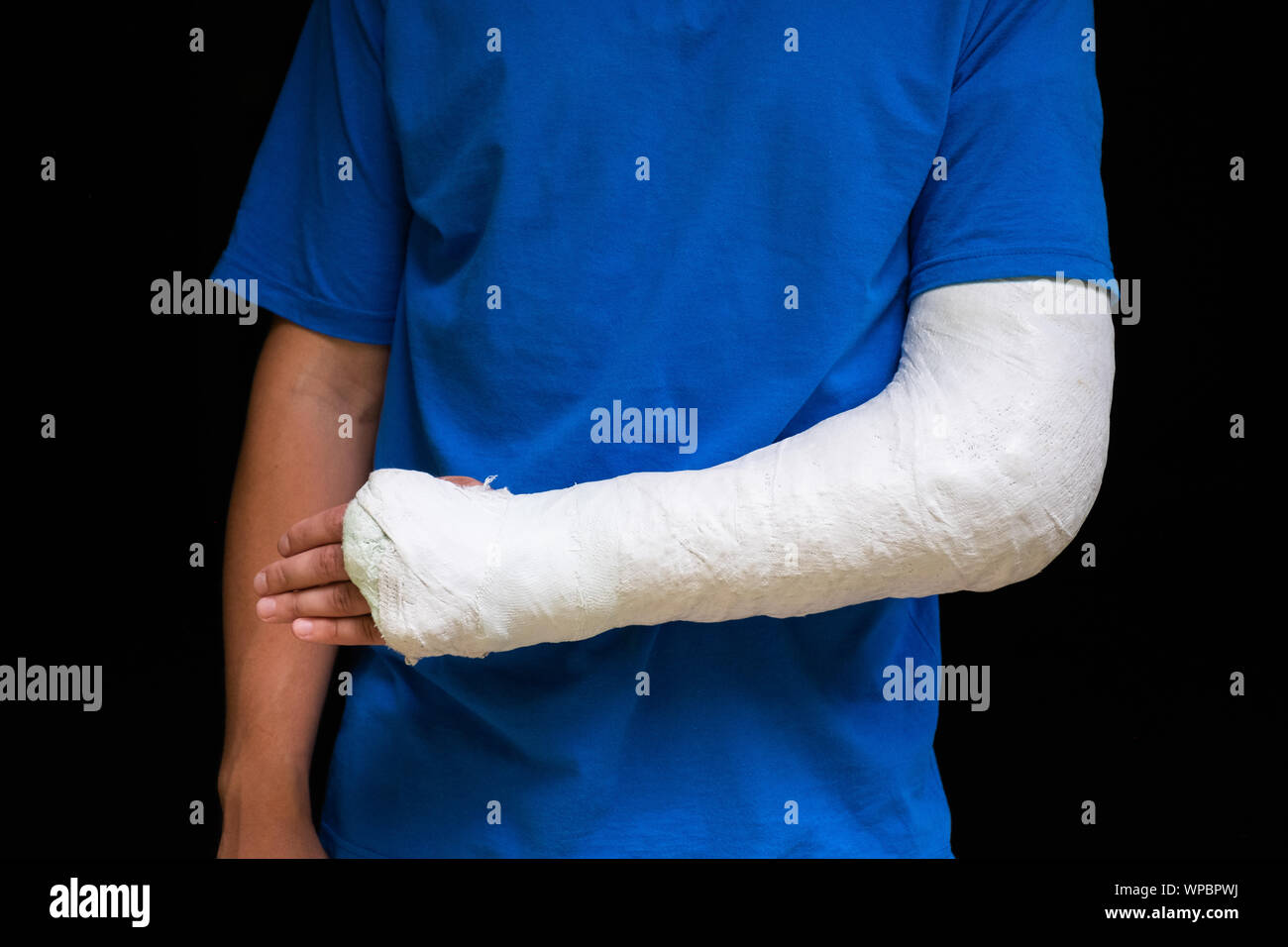 Uomo con braccio rotto avvolto medico gesso colato. Cast in fibra di vetro che coprono il polso e il braccio a gomito dopo sport incidente, isolato su nero Foto Stock