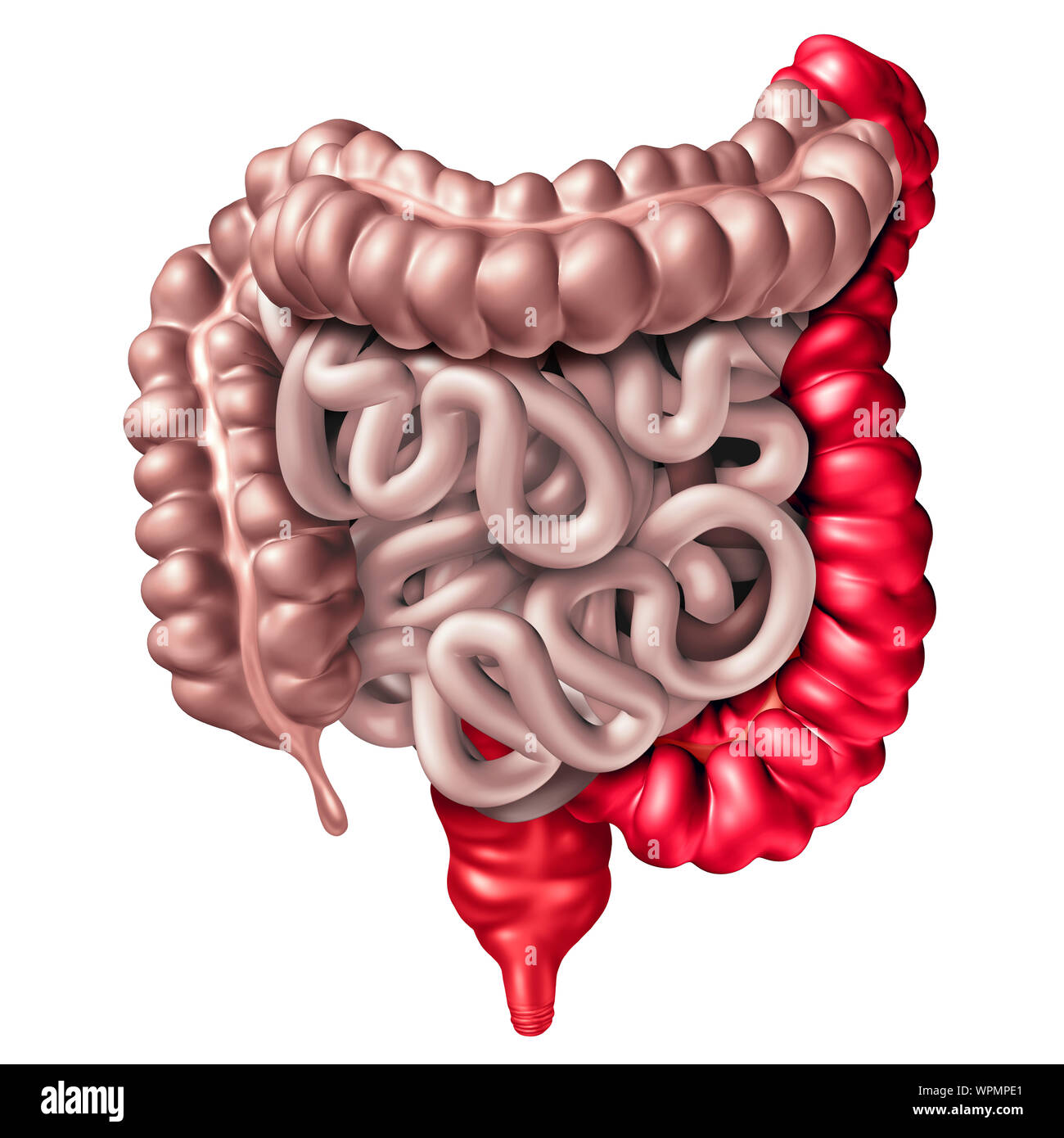 La colite ulcerosa come una malattia infiammatoria intestinale con un uomo retto e colon come un apparato digerente organo e la digestione della parte di corpo del concetto. Foto Stock