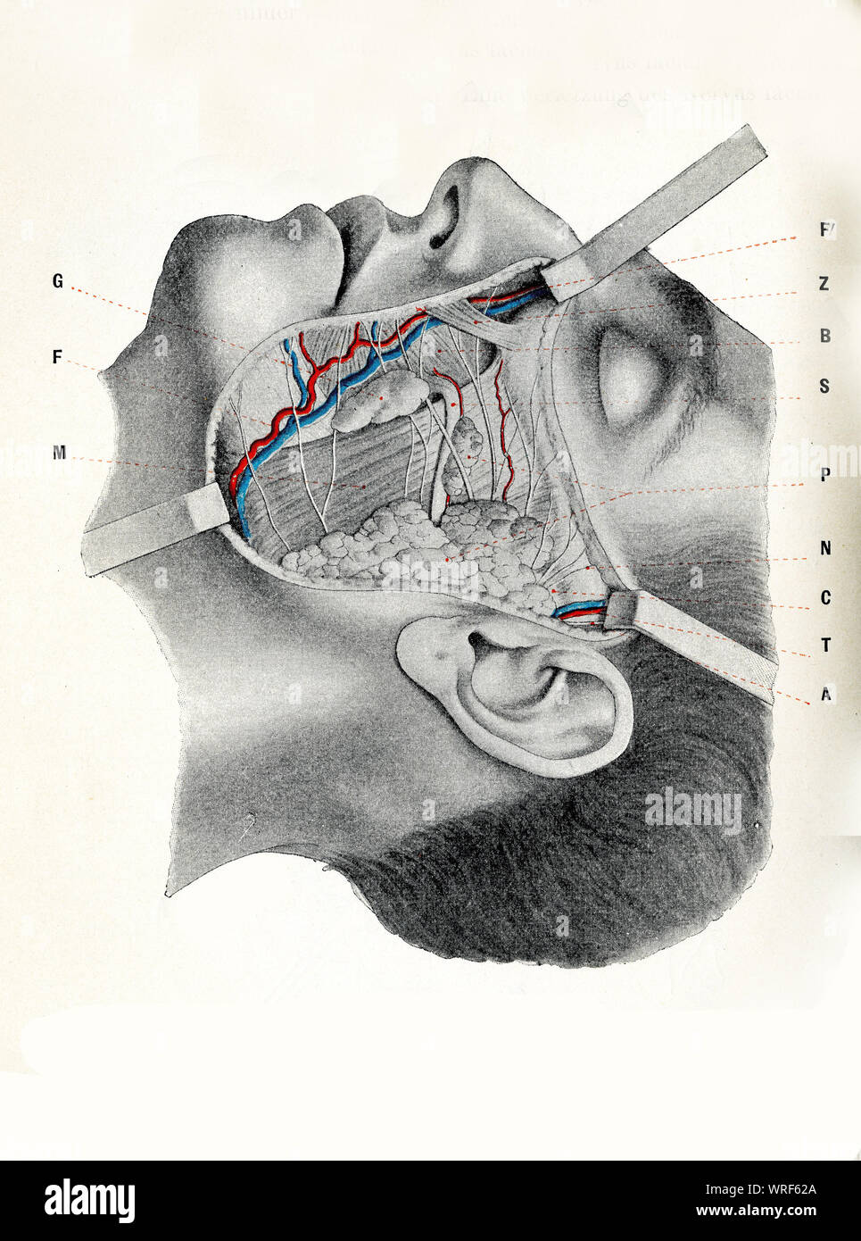 Chirurgia e medicina - guancia: regione sottorbitale, preauricolar e buccomandibular zonee esposta con la muscolatura del viso, arteria facciale e nella vena Foto Stock