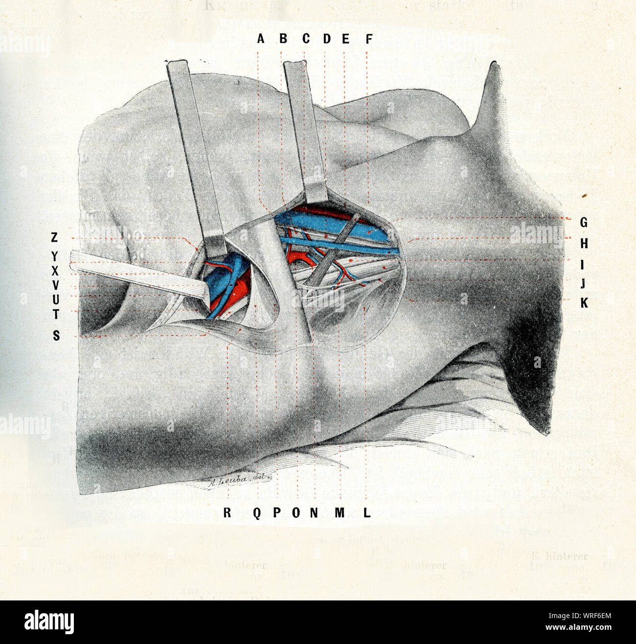 Chirurgia e medicina - Infraclavicular regione triangolare del torace sotto la clavicola (collare osso) tra il muscolo deltoide e pettorale i muscoli principali esposte Foto Stock