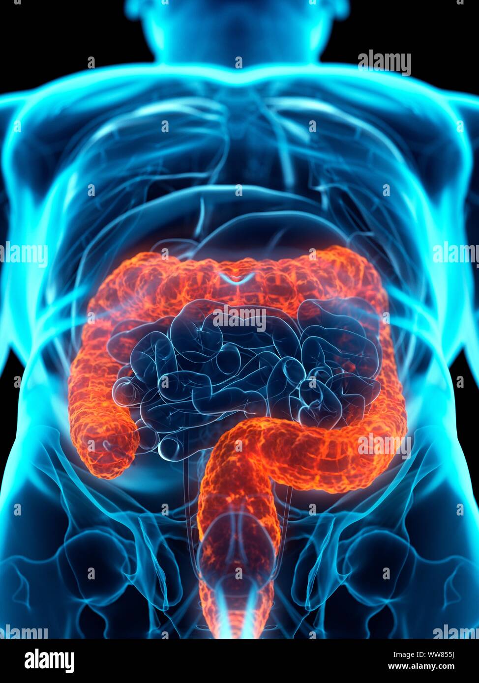 Colon malato, illustrazione concettuale Foto Stock