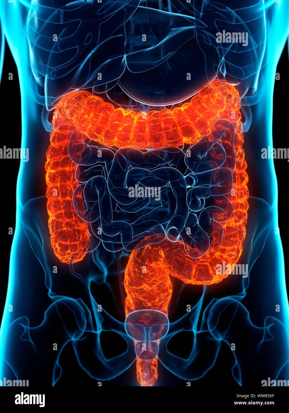 Colon malato, illustrazione concettuale Foto Stock
