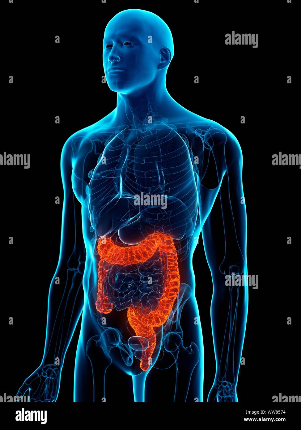 Colon malato, illustrazione concettuale Foto Stock