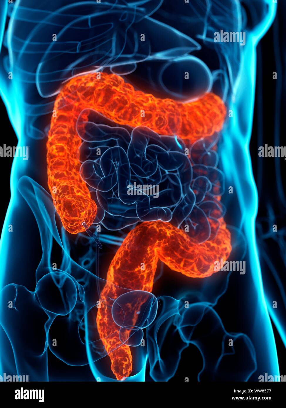 Colon malato, illustrazione concettuale Foto Stock