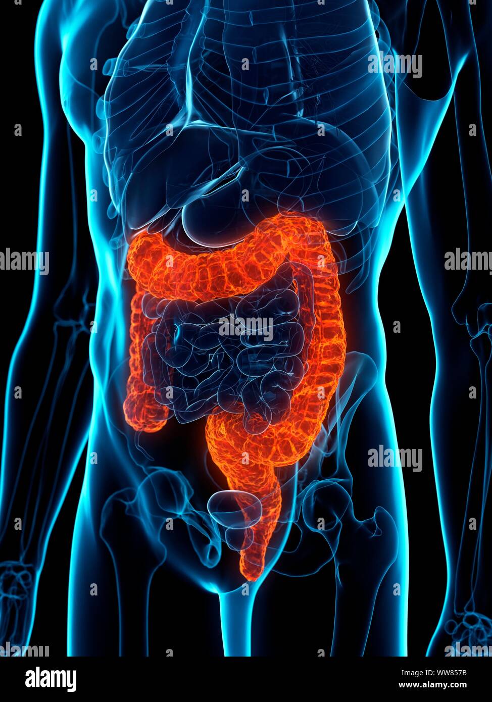 Colon malato, illustrazione concettuale Foto Stock