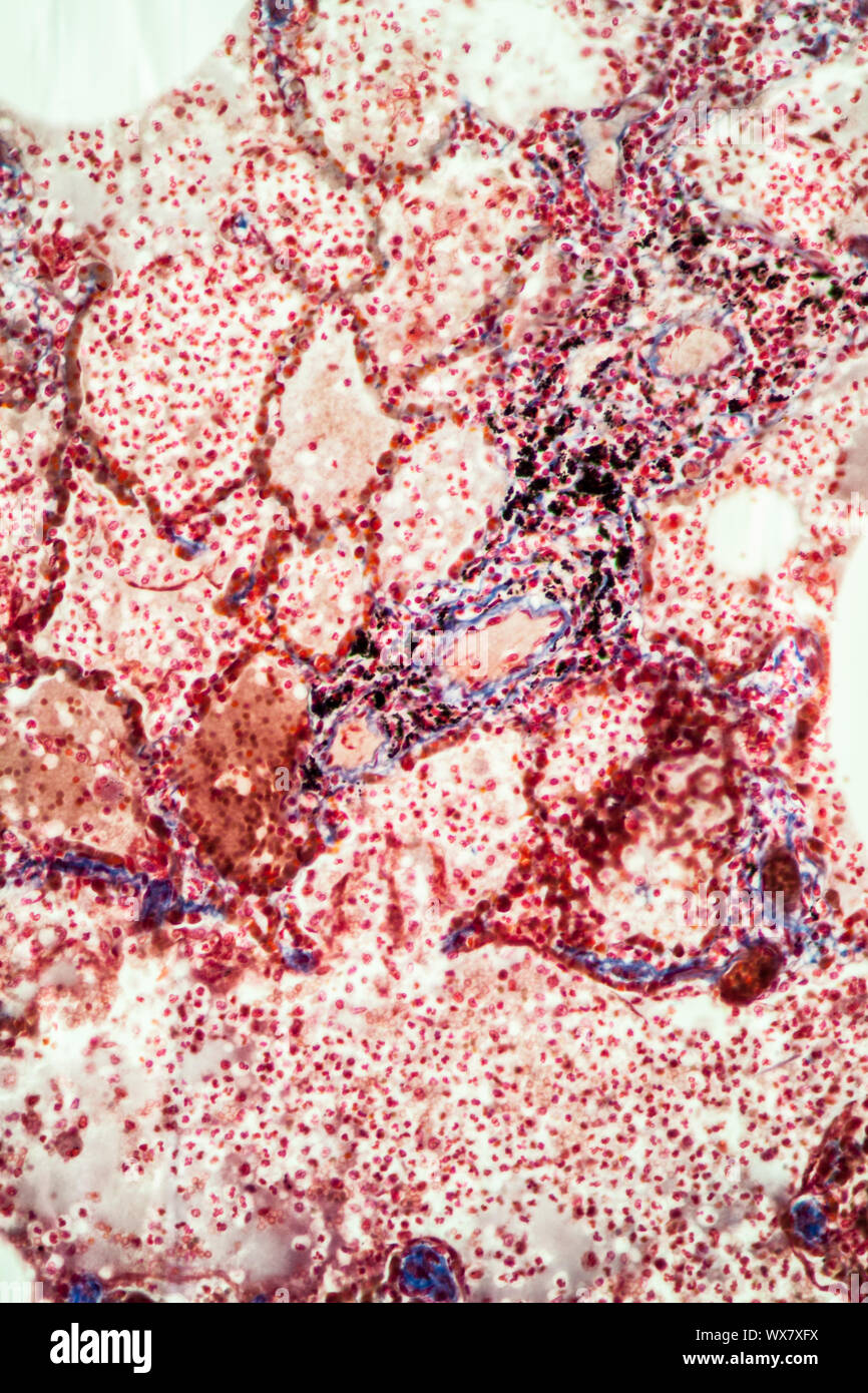 La tubercolosi polmonare tessuti sotto il microscopio 100x Foto Stock