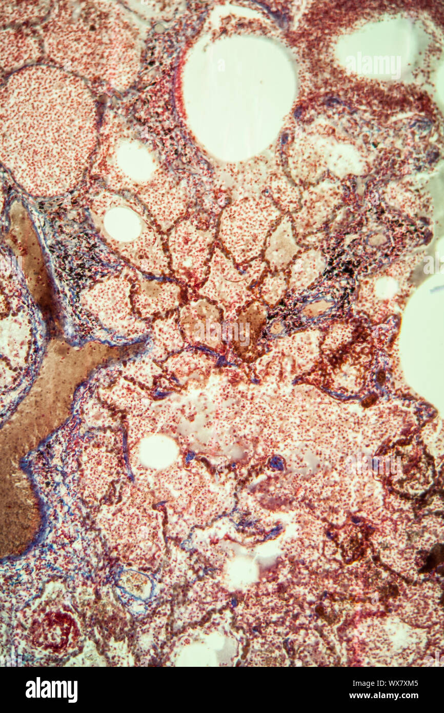 La tubercolosi polmonare tessuti sotto il microscopio 200x Foto Stock