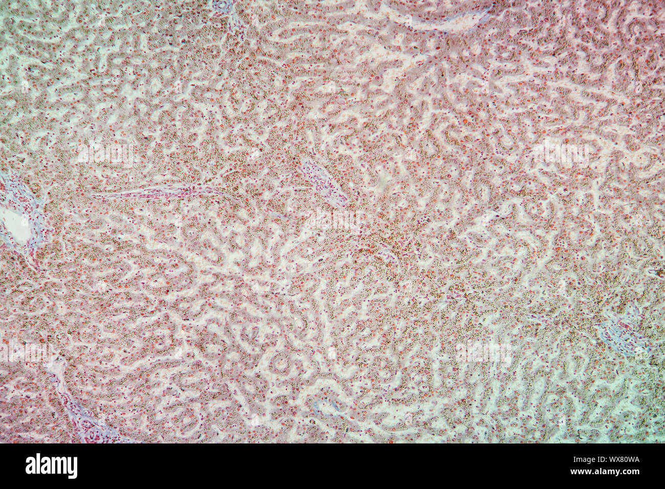 Emosiderosi del tessuto di fegato sotto il microscopio 100x Foto Stock