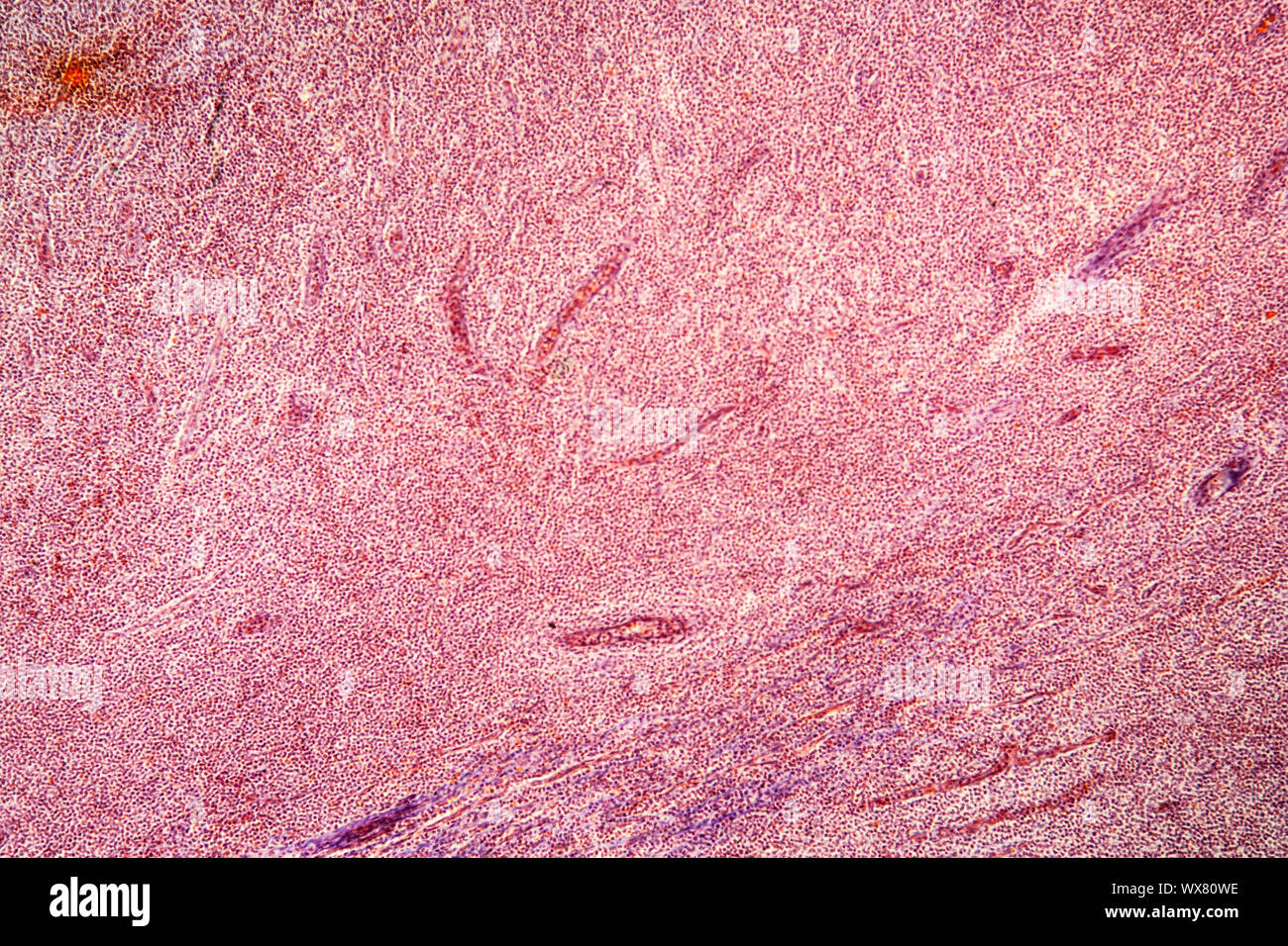 Tonsillite tessuto malato sotto il microscopio 100x Foto Stock