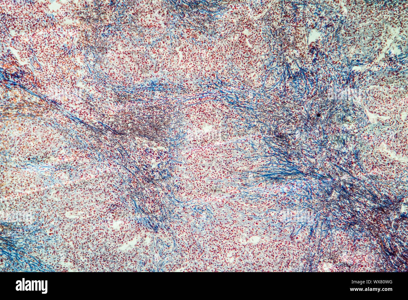 Cronica leucemia mieloide di milza di un tessuto malato 100x Foto Stock