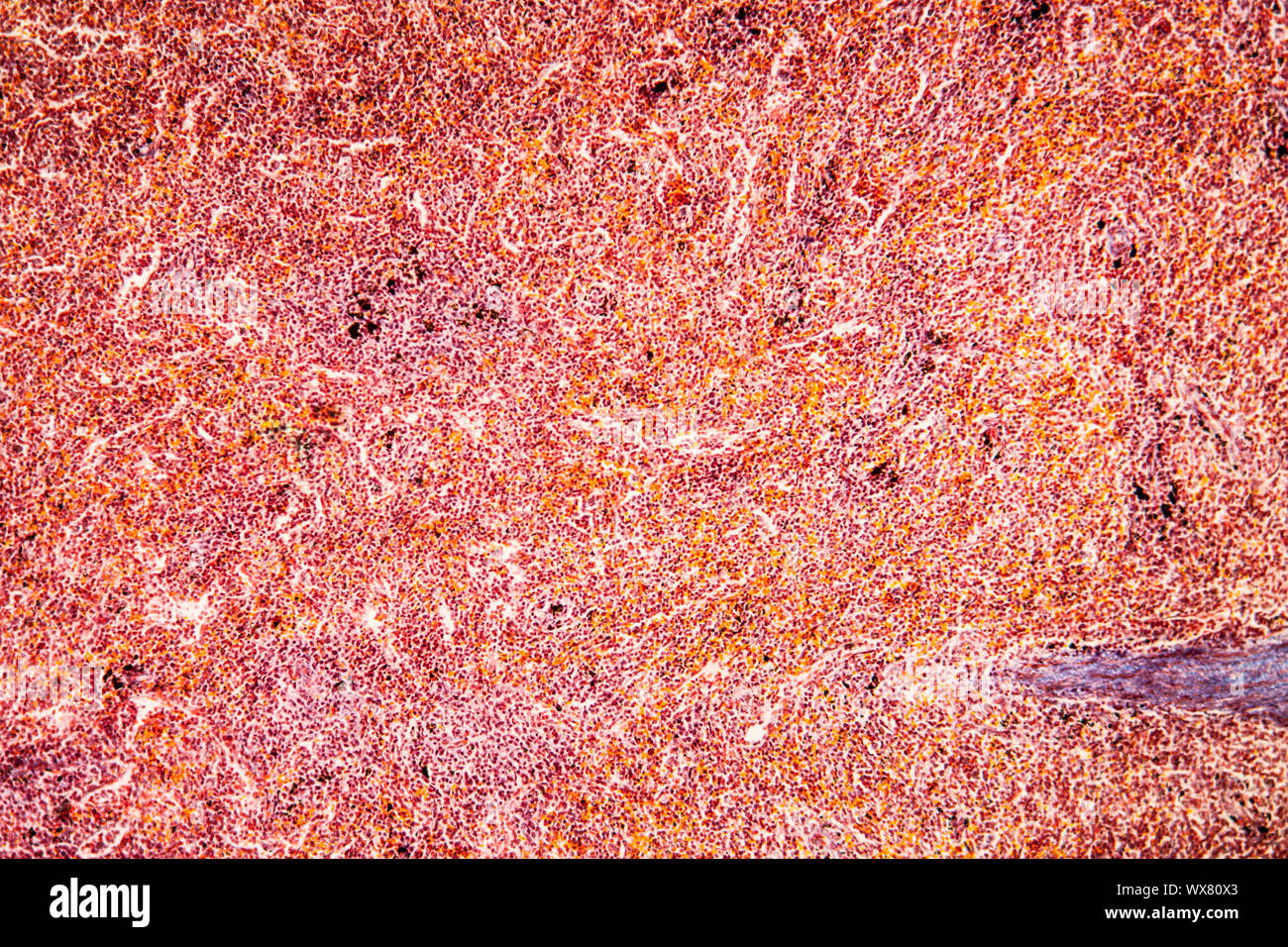 La malaria melanoma della milza di un tessuto malato 100x Foto Stock