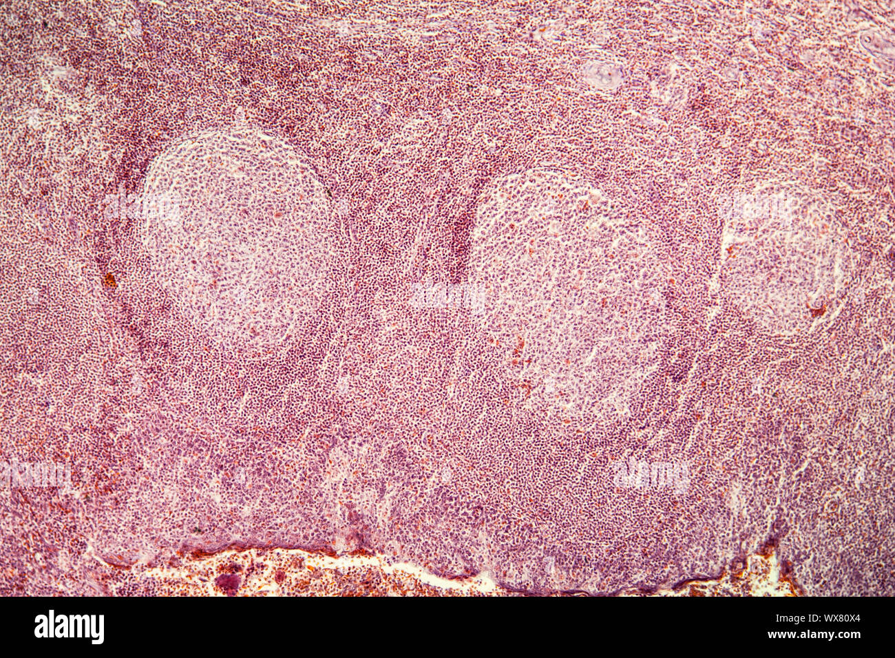 Tonsillite tessuto malato sotto il microscopio 100x Foto Stock