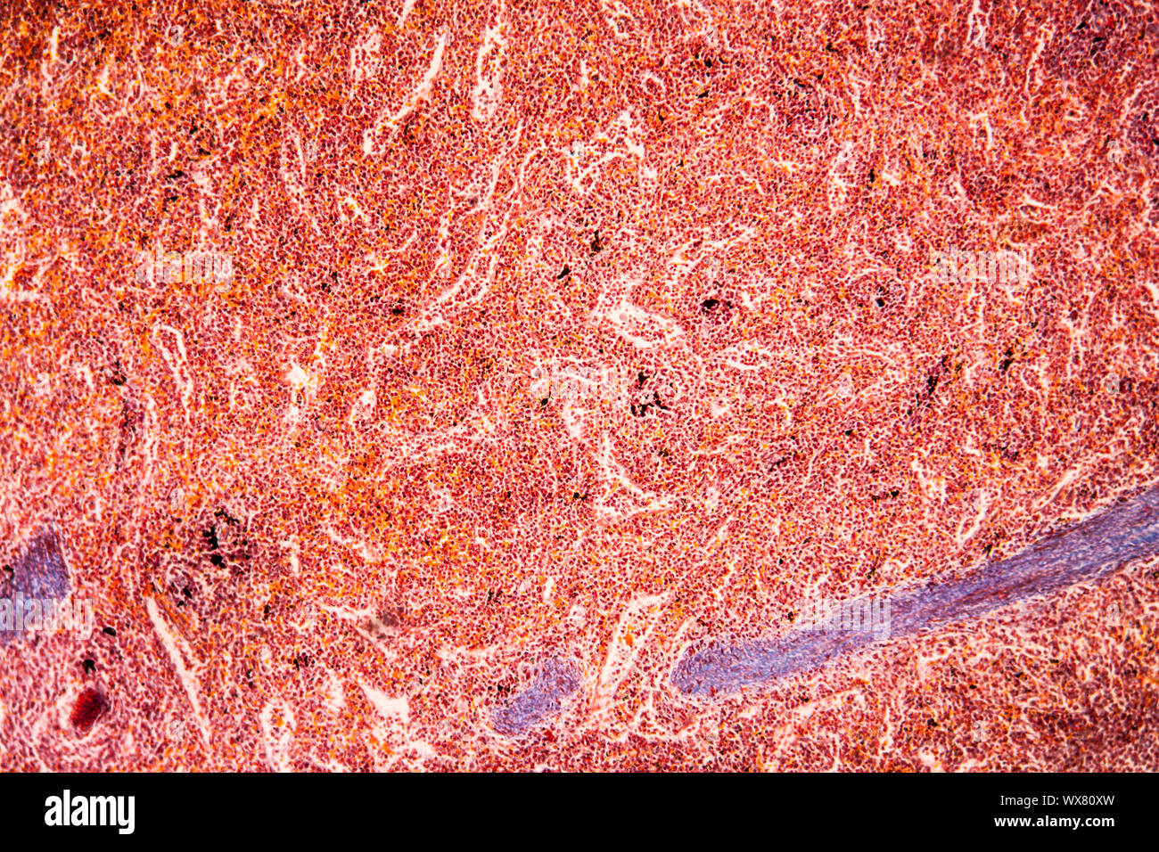 La malaria melanoma della milza di un tessuto malato 100x Foto Stock
